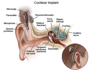hearing aid trial - ihear.in