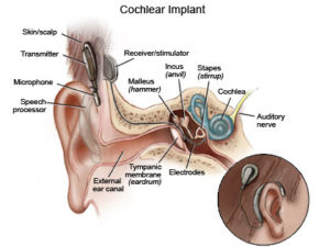 hearing aid trial - ihear.in